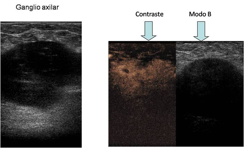 Udiat Centro Diagn Stico Ecograf A De Mama Con Contraste